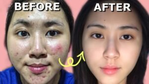 Cara Mengobati dan Menghilangkan Jerawat Secara Alami