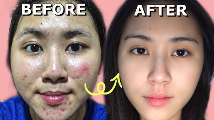 Cara Mengobati dan Menghilangkan Jerawat Secara Alami Cara Mengobati dan Menghilangkan Jerawat Secara Alami